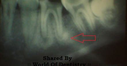 :: World Of Dentistry ::: Condensing Osteitis