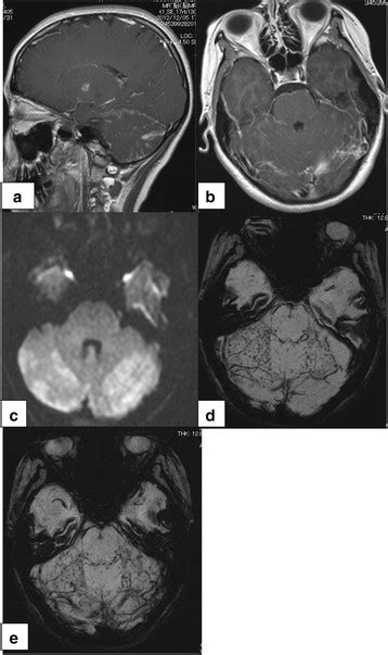 Brain Magnetic Resonance Imaging Of The Patient Postcontrast