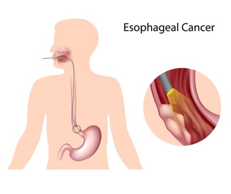 Radiation Therapy Treatment More Suited than Chemotherapy for Advanced Esophageal Cancer ...