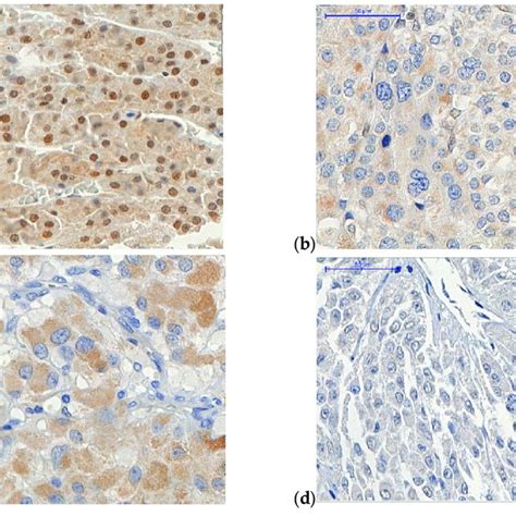 Adrenocortical Carcinoma Acc Samples Of Tissue Microarray Tma Obj Download Scientific