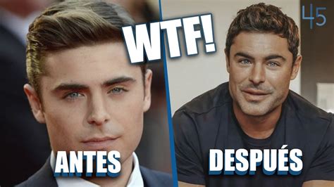 ¿quÉ Le PasÓ En La Cara A Zac Efron Youtube