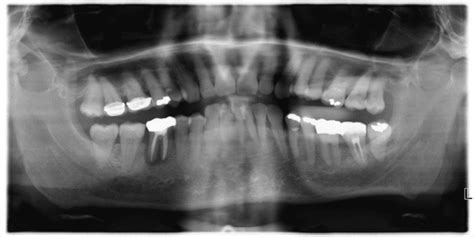 Jaw Bone Infection Or Osteomyelitis Find Out The Difference