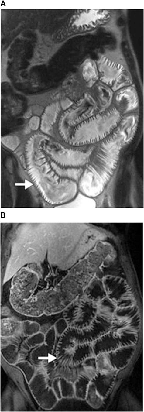 Involvement Of Small Bowel In Systemic Disease Ct And Mr Imaging