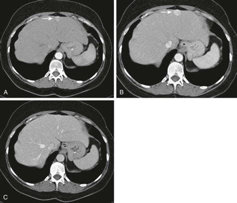 Benign Tumors Of The Liver Radiology Key