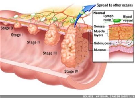 Stadiji Raka Debelog Crijeva