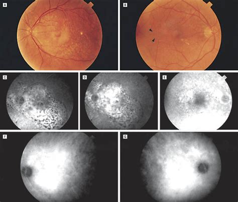 Leopard Spot Pattern Of Yellowish Subretinal Deposits In Central Serous