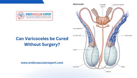 Can Varicoceles Be Cured Without Surgery EndovascularExpert