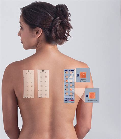 T R U E Test Patch Test Panels Smartpractice Dermatology Allergy