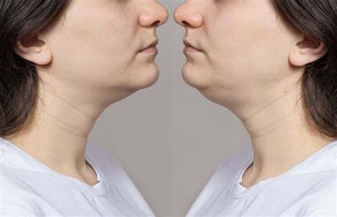 How to Lose Double Chin Fat: Our Top 4 Treatments - Edmund Fisher ...