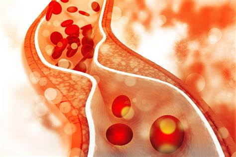 Lipoproteine a bassa densità in aterosclerosi e malattie cardiache SISMED