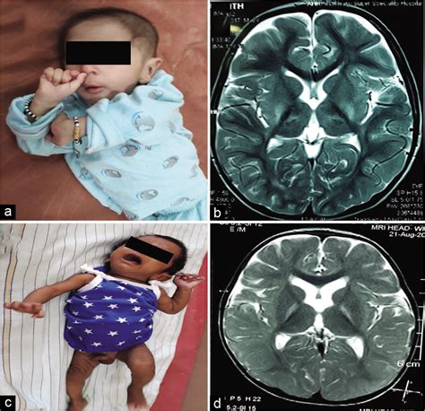 Recent Advances In Cerebral Palsy Karnataka Paediatric Journal