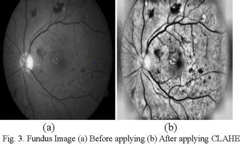 Figure 3 From Diagnosis Of Diabetic Retinopathy Via Classification Of