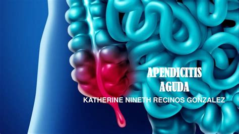 Apendicitis Aguda Med Cartoon UDocz