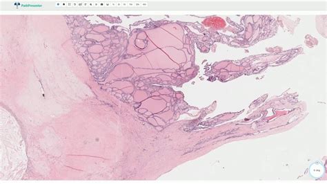 Multinodular Goiter Removal