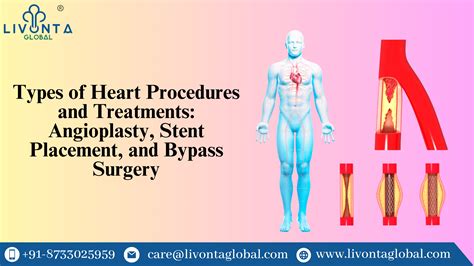 Types Of Heart Procedures And Treatments Angioplasty Stent Placement