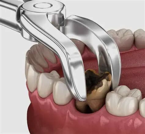 tooth removal  shyamal tooth removal  satellite tooth removal