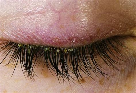 Blepharitis - Dry Eye Therapy