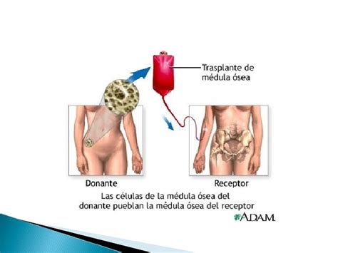 Trasplante De Medula Osea