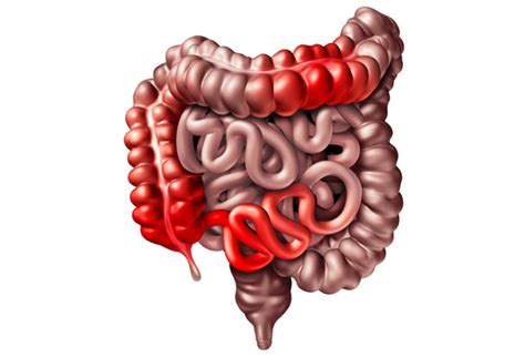 Spondyloartritis En Activiteit Van De Ziekte Van Crohn Ortho Rhumato