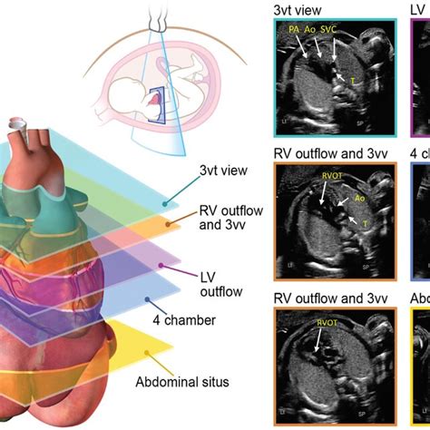 Short Axis Views Of The Fetal Heart A Shows The High Short Axis At