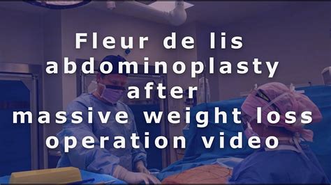 Transformative Operation Technique Fleur De Lis Abdominoplasty With