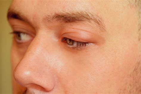 Blepharitis Eyelid Inflammation Causes Symptoms And Treatments