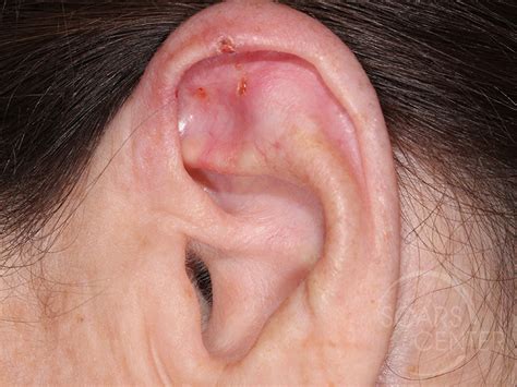 Squamous Cell Carcinoma Ear