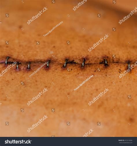 surgical suture stock photo  shutterstock