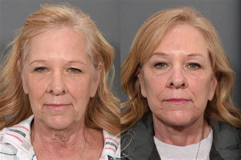 Facelift Before After Photos Patient 1433 Serving Rochester