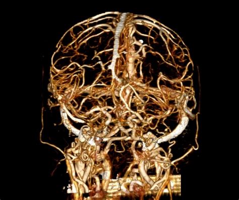 Normal Head Ct Angiogram Image Radiopaedia Org