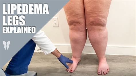 Lipedema Legs Explained | Dr. Jaime Schwartz | Total Lipedema Care ...