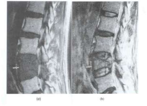 Figure 3 From Review Of Malignant And Benign Findings Of Compression Vertebral Fractures On Mri