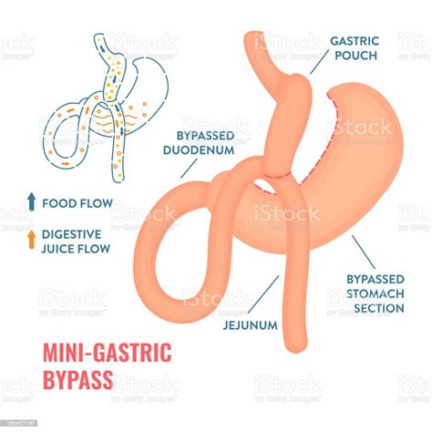 Mini Gastric Bypass Bariatric Surgery Weight Loss Infographics Stock