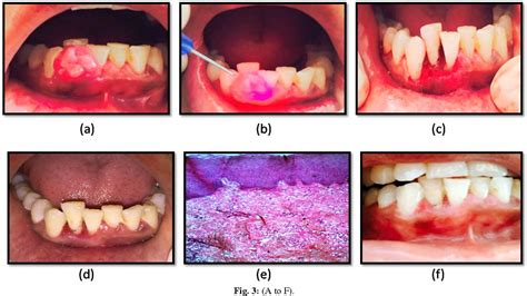 Figure 3 From Diode Laser For Excisional Biopsy Of Pyogenic Granuloma