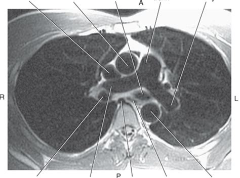 Axial T1 Weighted MRI Of Chest With Pulmonary Trunk Diagram Quizlet