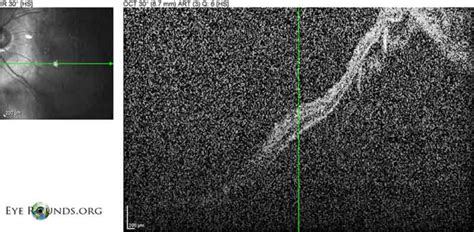 Rhegmatogenous Retinal Detachment Macula Off The University Of Iowa