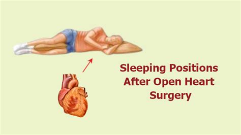 Sleeping Positions After Open Heart Surgery: 10 Things to Know