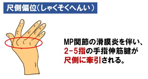 関節リウマチについて正しいのはどれか【第53回理学療法士国家試験am87】 — 理学療法士国家試験対策ptes