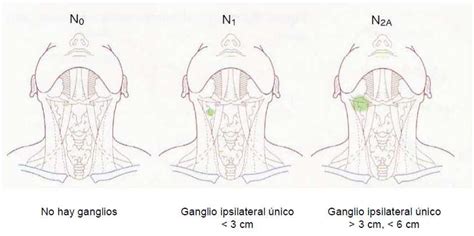 Manejo Del Cuello En El Cáncer De Laringe Gaes Orl Guide