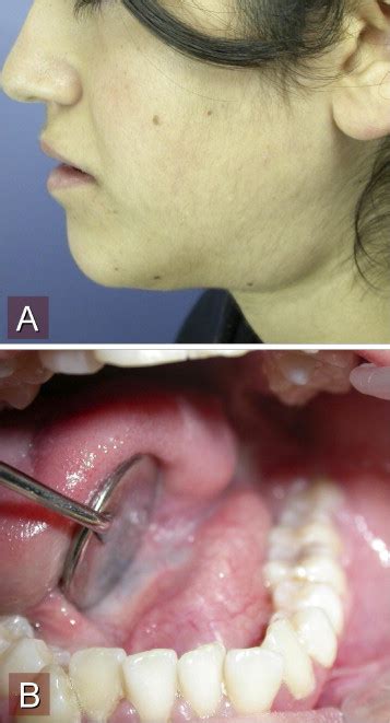 Floor Of Mouth Dermoid Cyst Viewfloor Co