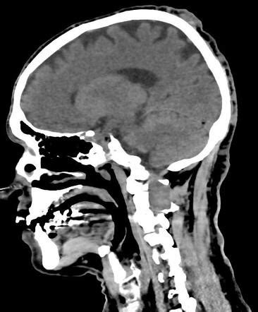 Spinal Schwannoma Cervical Image Radiopaedia Org