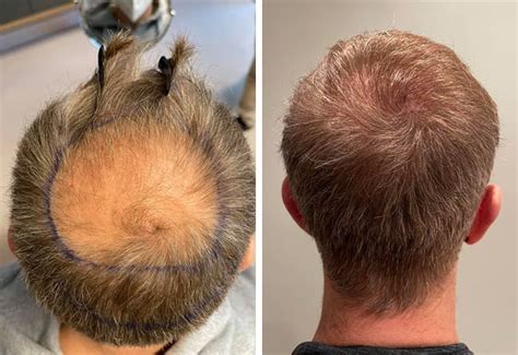 Ergebnisse Der Haartransplantation Vorher Nachher Bilder Elithair