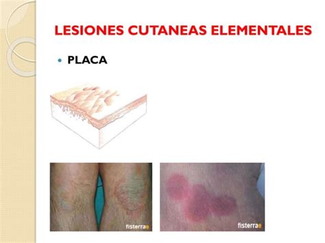 Lesiones Cutaneas Elementales Dermatologia Efrain Negrete PPT