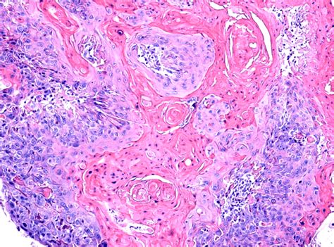 Microscopic Image Of A Well Differentiated Squamous Cell Carcinoma