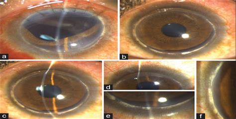 Globe rupture following eye rubbing in a case of Terrien's m... : Indian Journal of Ophthalmology