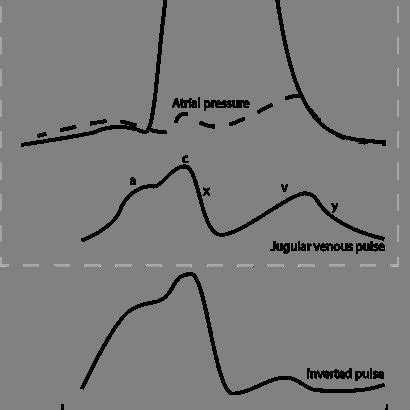 Comparison of a typical "inverted" pulse to the jugular venous pulse ...