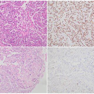 Depiction of Endometrial Clear Cell Carcinoma. The two panels on the ...