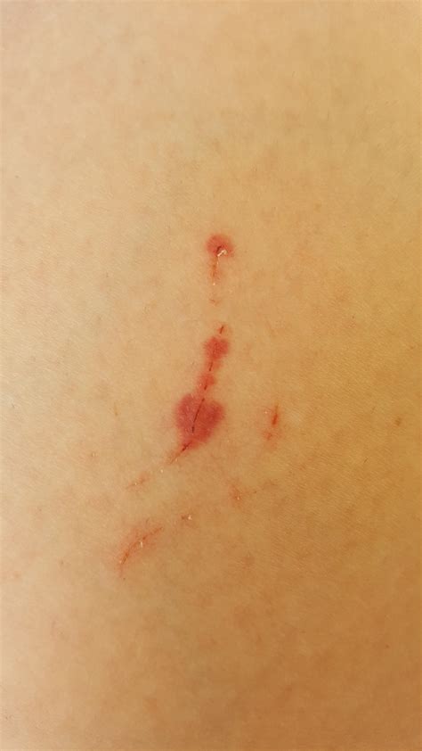 I started bleeding under my skin recently every time I get the smallest