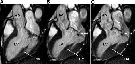 Cardiovascular Magnetic Resonance Imaging For Valvular Heart Disease