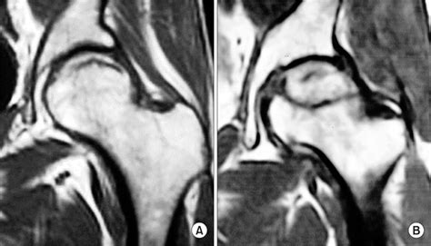 Subchondral Insufficiency Fractures Of The Femoral Head